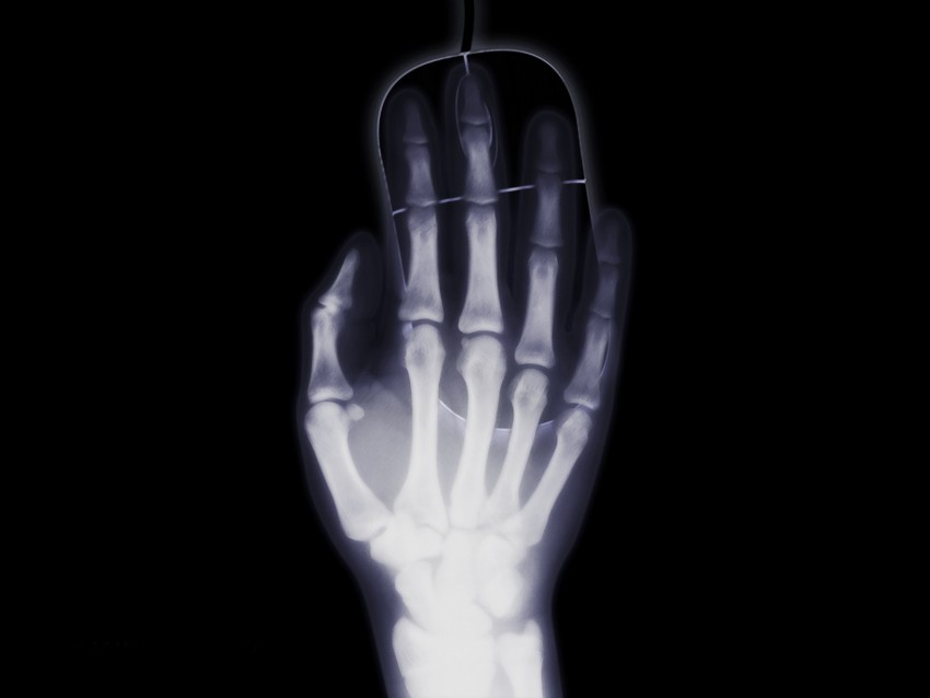 arm, x-ray, bone, computer mouse