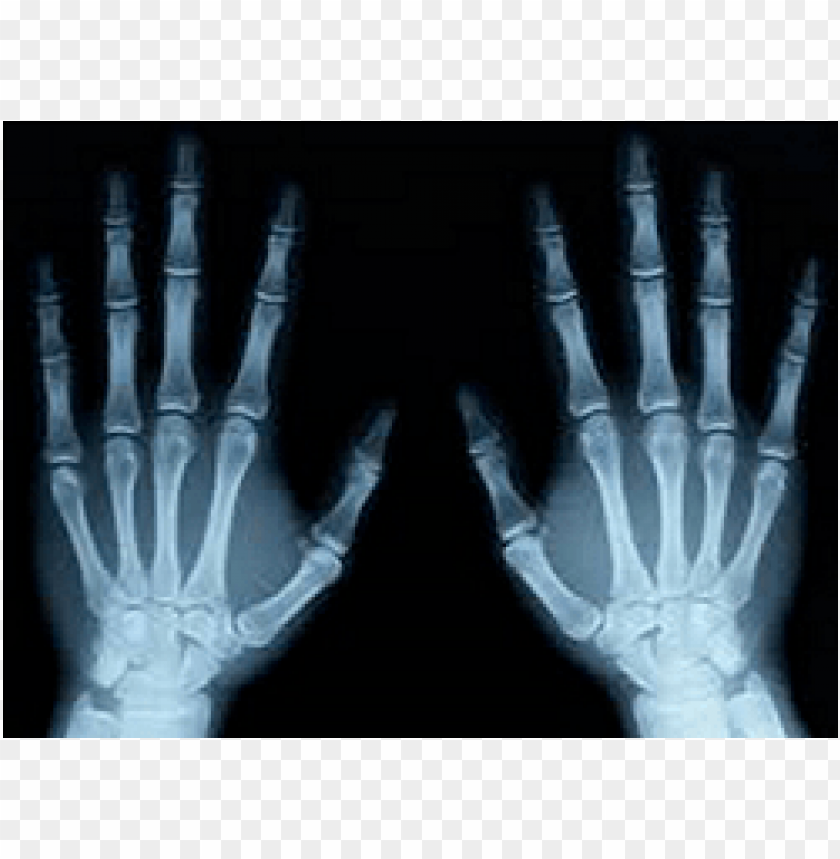 x-ray of both hands PNG image with transparent background@toppng.com