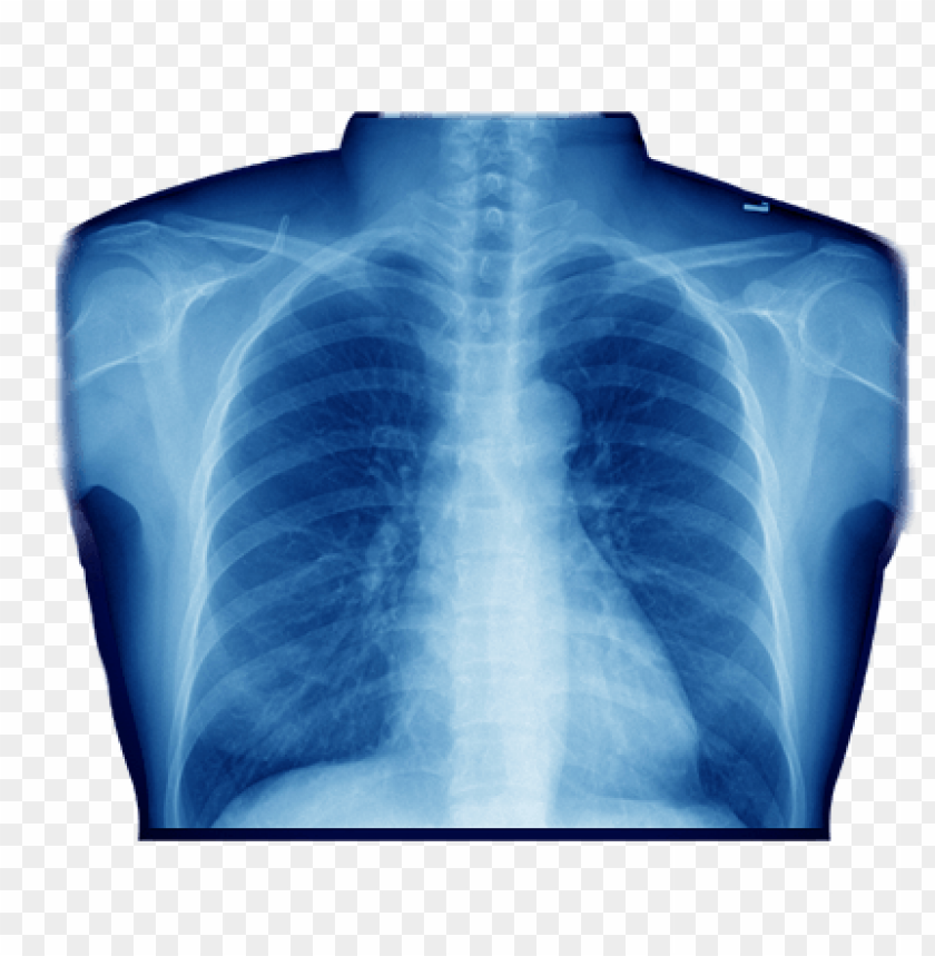 X-ray Of Chest PNG Image With Transparent Background